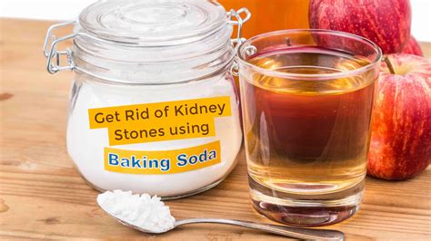 Learn more at St Pete Urology. . Baking soda and kidney stones
